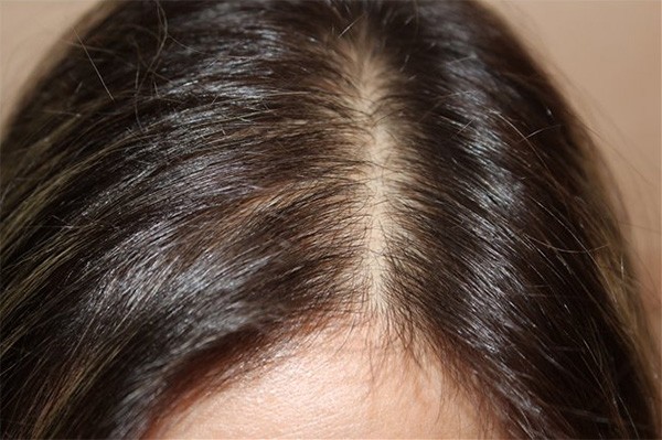 Как остановить выпадения волос у женщин?